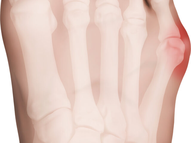 内反小趾で「幅広の靴」は逆効果？小指の痛みが治らない原因とは？