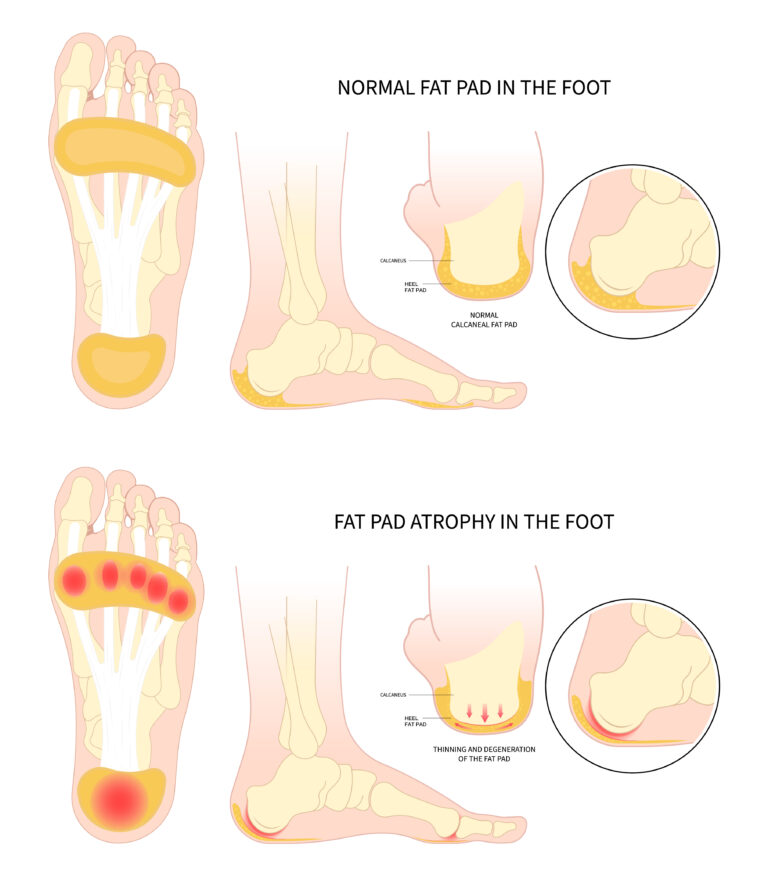 Painful heel bone spurs in Plantar fat pad atrophy tear high ankle ...